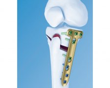 Depuy Synthes TomoFix Medial High Tibial Plate (MHT) | Which Medical Device